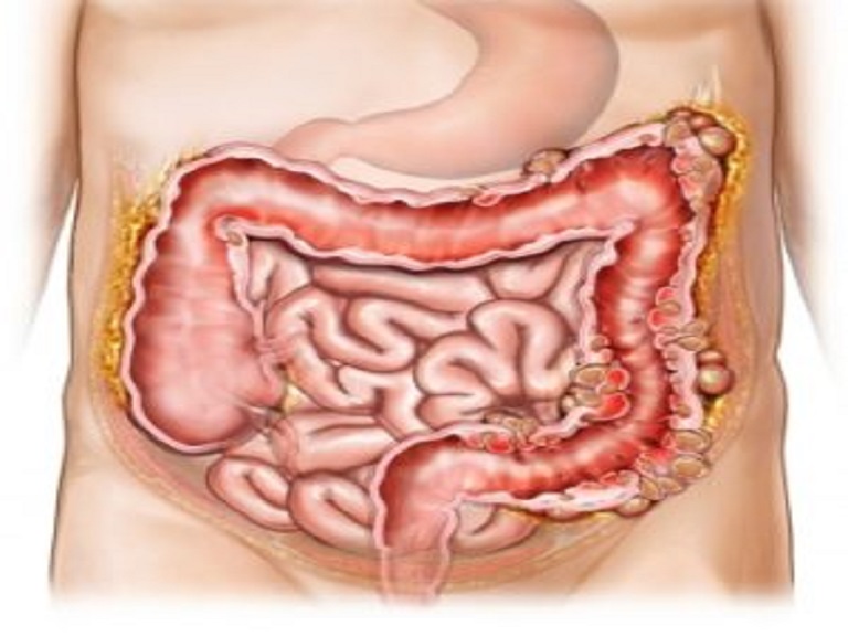 amlapitta ayurvedic treatment