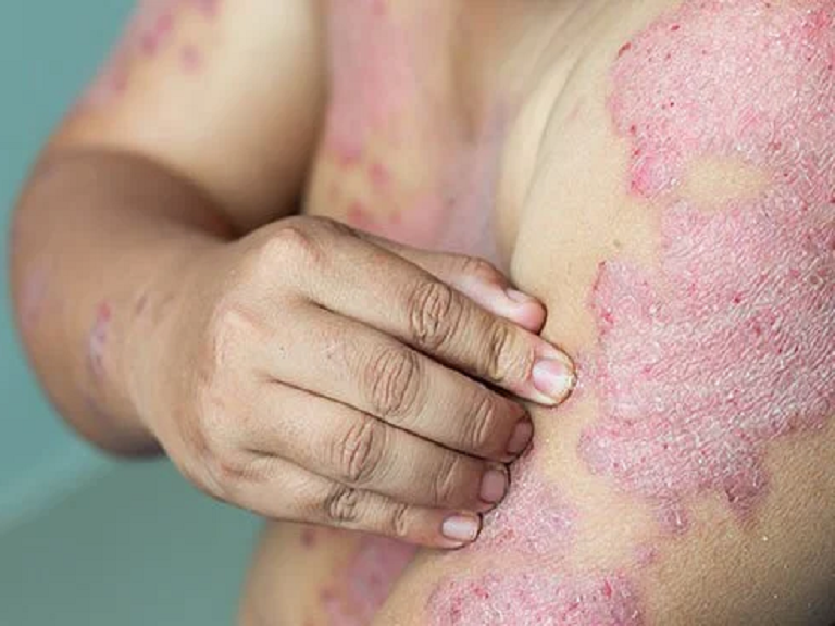 ayurvedic treatment for psoraisis