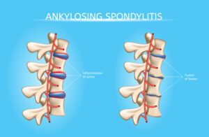 Effective Ayurvedic Treatment for Ankylosing Spondylitis at Risha Ayurveda