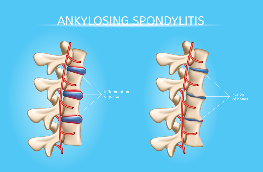 Effective Ayurvedic Treatment for Ankylosing Spondylitis at Risha Ayurveda