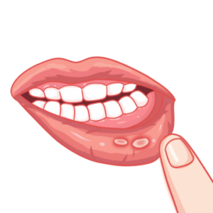 Top 5 home remedies for mouth ulcers