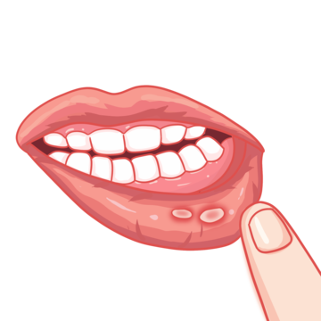 home remedies for mouth ulcers