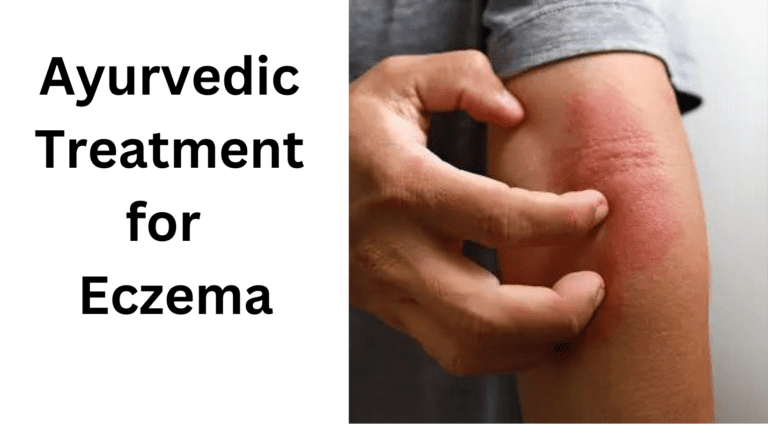 Ayurvedic treatment for Eczema