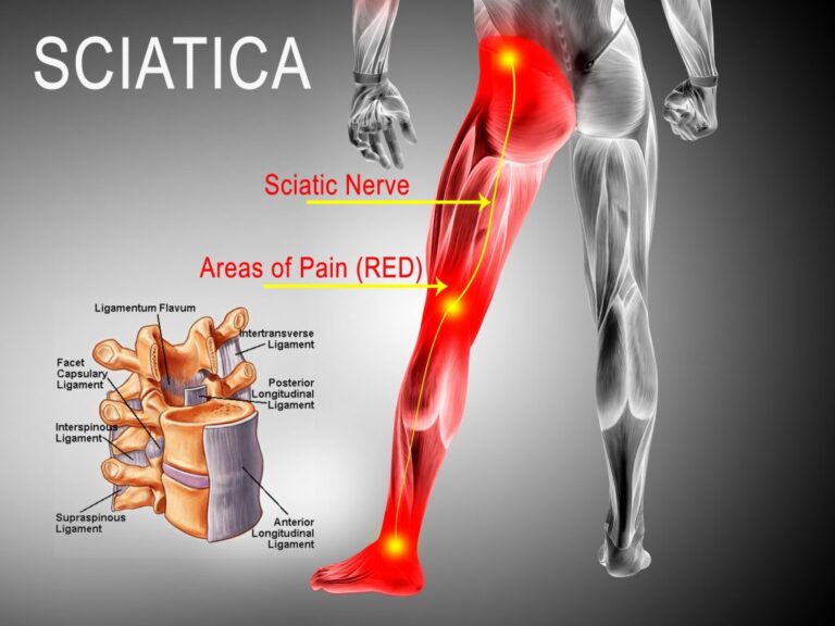 ayurvedic-treatment-for-sciatica